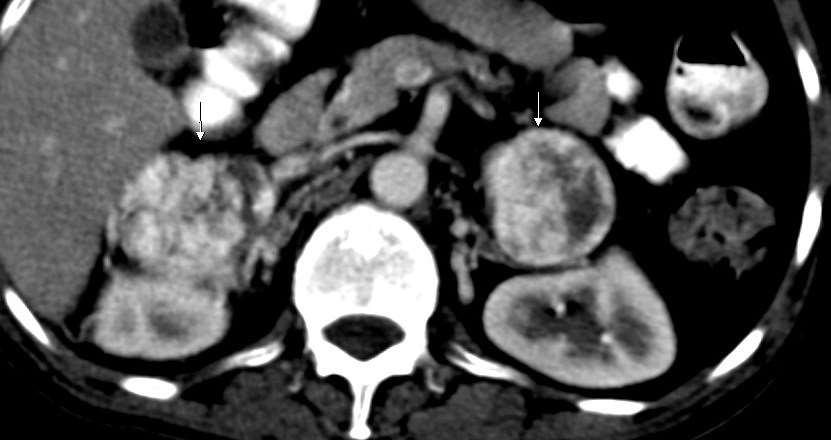 Phaeochromocytoma Semimalignus daganat 10 %: családi halmozódás, 10%: kétoldali, 10% malignus transzformáció Felnőttekben a