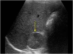 gyakori, inhomogén erőteljes halmozás Extradrenerg lokalizációk: paracavalis sympaticus ganglion lánc, mediastinum, szív,