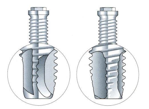 menetvágó típusú) implantátumok bevezetése csak puha csont 1987 és 1990 között