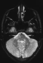 Differenciál diagnosztika : Monophasisos