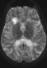 lánynál Neuromyelitis optica Devic Akut opticus