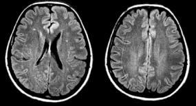 diagnosztika: különleges demielinizáció