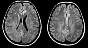 diagnosztika: különleges demielinizáció