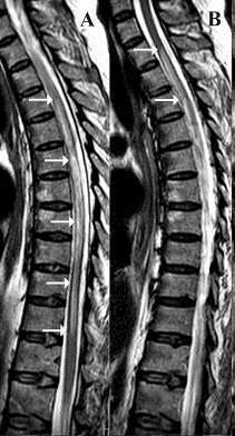 multifokális leukoencephalopathia natalizumab