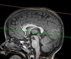 Mikroanatómia Entorhinalis és perirhinalis cortex MRI