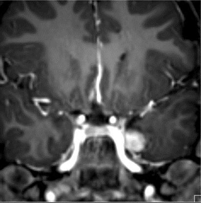 Bal T medialis