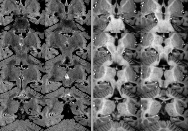 Miért kell használni az MR protokollt? NEURODEGENERATÍV KÓRKÉPEK: DEMENTIA, MOZGÁSBETEGSÉGEK Dementia: Miért kell képalkotó vizsgálat? 1.