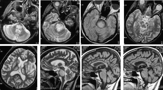 Degeneratív agyi kórképek 1. Acut hypertensiv encephalopathia (PRES) 2.