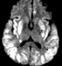 hypoglycaemia Csecsemő-gyermekkorban és felnőtt korban is epilepsziás görcsök, stupor-kóma a