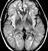 globus pallidus T1 jelfokozódása