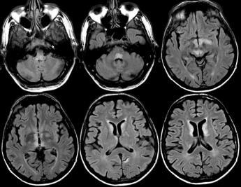 Wernicke-encephalopathia Ataxia, szemmozgászavar, confusio, polyneuropathia Korsakoff pszichózis (amnesticus