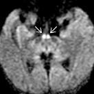 thalamus, hypothalamus, periaqueduct. SZÁ kóros jel, halmozás, diff. gátlás, vérzés lehet (metanol!