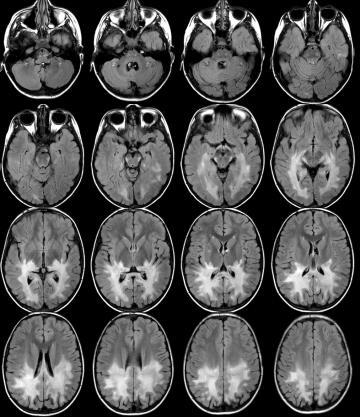 adrenoleukodystrophia