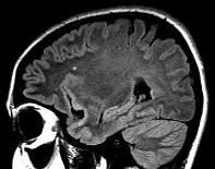 Példák Sarcoidosis, SLE, vasculitis,