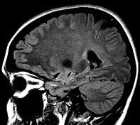 syphilis, chronicus meningitis