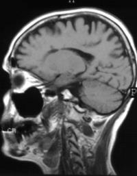 myelopathia, lymphoma (primer cerebralis,