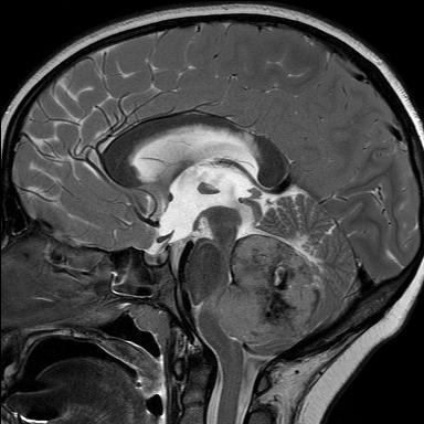 Kisagy és h{tsó agyfélteke, posterior vermis, IV.