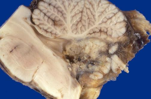 leptomeningealis disseminatio Alacsony glucos szint, tumorsejtek a liquorban Extracranialis