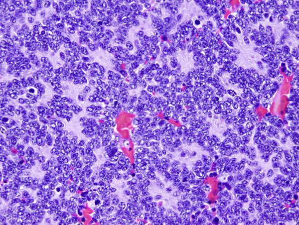 Klasszikus medulloblastoma: Kis, kék, kereksejtes tumor Differenci{latlan, embryonalis