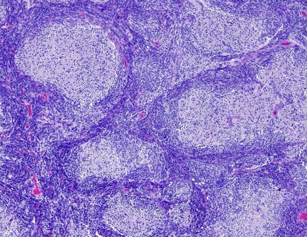 nodularis medulloblastoma: Differenci{latlan tumorsejtek, jellegzetes nodularis morphologia,