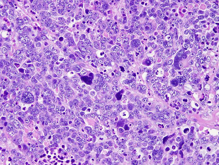 Kiterjedten nodularis szerkezet, neuropil Nagysejtes / anaplasticus medulloblastoma: Anaplasia,