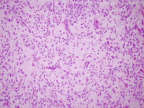 2. Ganglioneuroblastoma