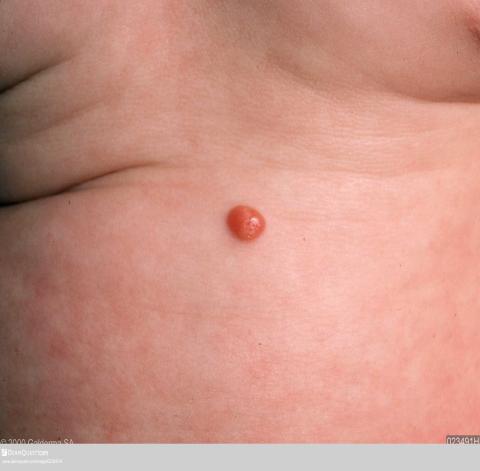 3. Fibrosus tumorok: myofibromatosis (benignus focalis