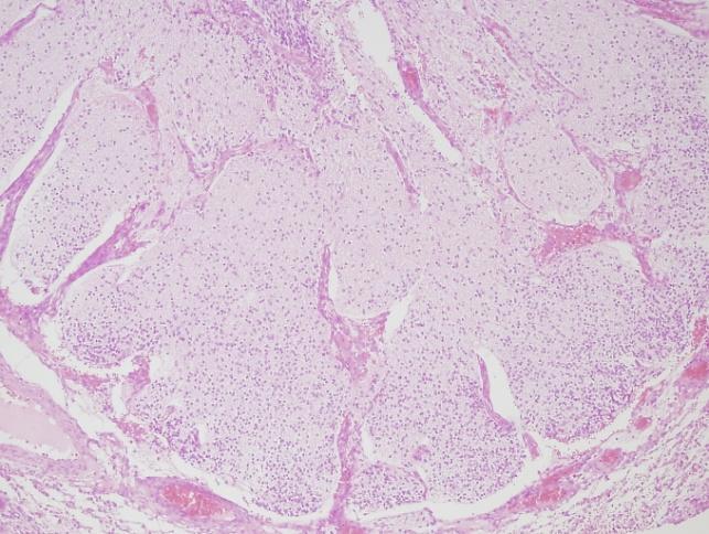 sacrococcigealis testicularis, ovarialis, mediastinalis,