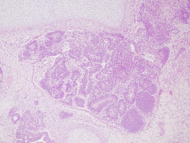 malignus (éretlen szöveti elemek, neurotubulusok) https://www.