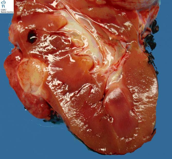 WILMS TUMOR prolifer{ló metanephricus blastema norm{lis tubul{ris és glomerul{ris differenci{ció nélkül perziszt{ló