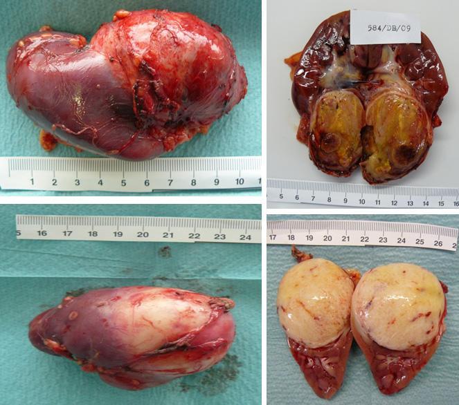 vizeletben (20%) hypertonia metastasis: tüdő