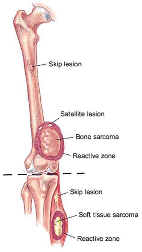 OSTEOSARCOMA mesenchym{lis eredetű primitív sejtekből sz{rmazik, melyek osteoblastos