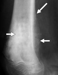 Jellemzők: metaphysealis szakasza a csöves csontoknak leggyakrabban a tibia proximalis vége vagy a humerus és femur distalis vége solid