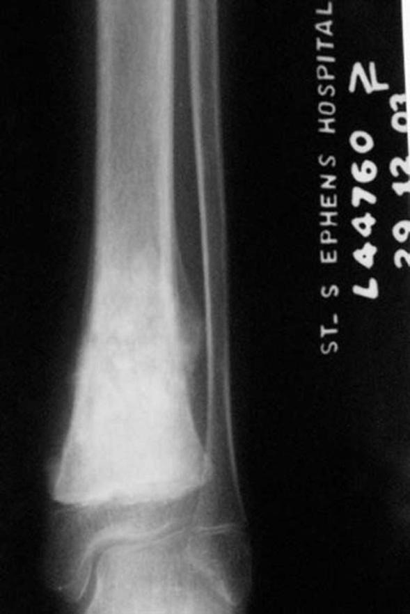 elemelkedése miatt (patológi{s csontújraképződés) Chondroblastic Osteosarcoma of the Lower Tibia: A case report by J.