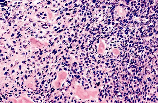 Szövettan: Osteoid (tumorsejtek {ltal termelet amorf, eosinophil anyag