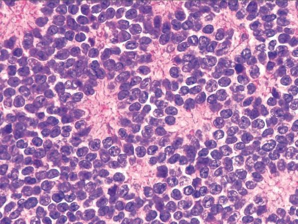 pathologyoutlines.com Periféri{s PNET hasonló szövettani megjelenés Diff.