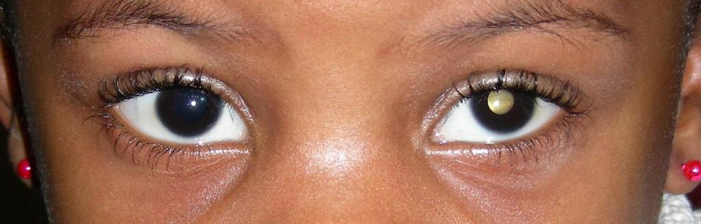 RETINOBLASTOMA Az első életévben 10-15 %-ban előforduló leggyakoribb primer intraocularis malignus tumor Az esetek többsége 2 éves kor előtt kerül felismerésre Az esetek 1/3-a kétoldali Csal{dban