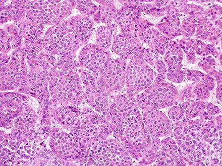 com/malignantpediatric-liver-tumors/ Tiszt{n