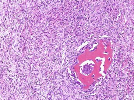 mesenchymalis elemek) osteoid A tiszt{n fetalis tipusú