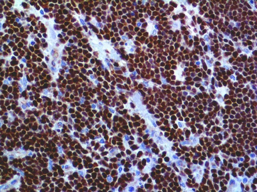 LEUKAEMI[K Acut lymphoblastos leukaemia/lymphoma precursor B (pre-b) vagy T (pre-t) lymphoblastok 85 % pre-b sejtes tumorok Típusos gyermekkori acut