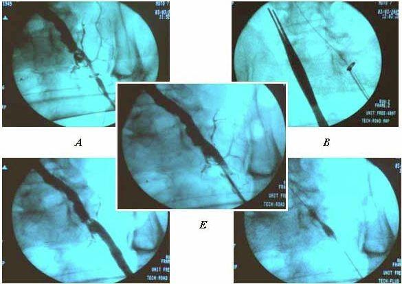 1. ábra. A: Intraoperatív retrográd angiographia. B: "over-the-wire" ringstripper desobliteratio. C: kontroll angiographia, szignifikáns reziduális stenosis. D: stent implantáció.