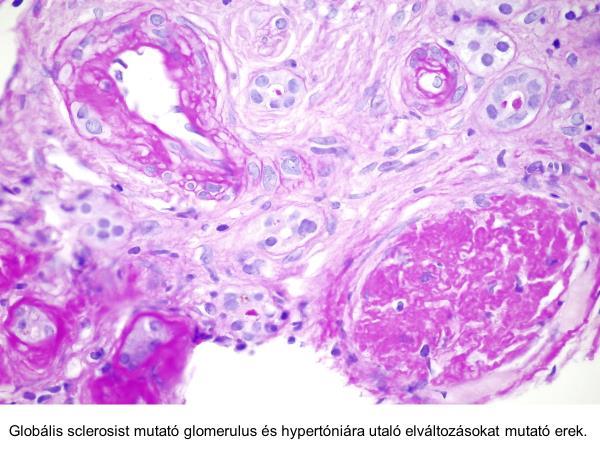 Proliferatív elváltozás a glomerularis struktúrákban a focalisan megfigyelhető parietalis podocyta proliferation kívül nem azonosítható.