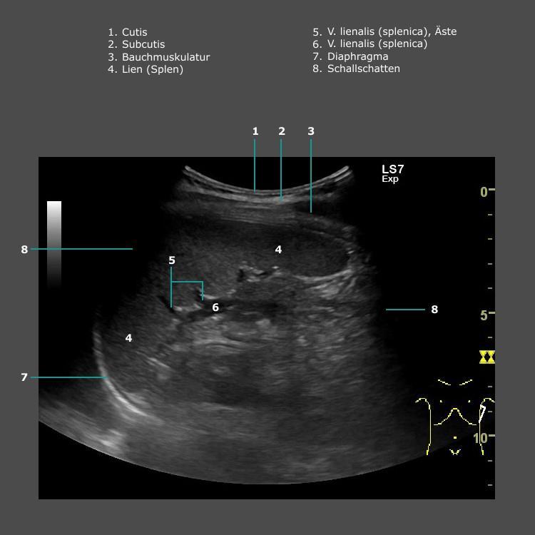 Splenomegalia diagnózisa anamnézis (infekciók?