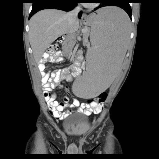 Splenomegalia - stádiumbeosztás Enyhe splenomegalia: lép súlya < 500 g oka: lázzal járó bakteriális fertőzések Középsúlyos splenomegalia: lép súlya 500 800 oka: kr.