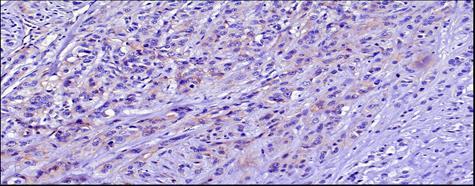 A vizsgálatainkba bevont PEHE tumor in vitro immunhisztokémiai eredménye szerint CD31 3+, Ki67: + (>30%), CD34 és VIII.