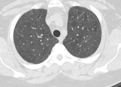 Sjögren-szindróma pleuropulmonalis manifesztációi Tracheitis, laryngitis sicca, bronchitisek Recidíváló