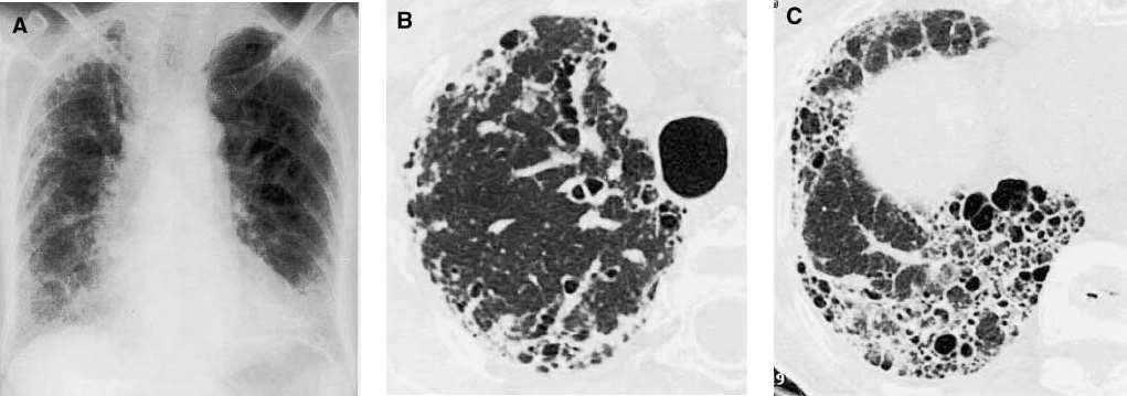 Dominálóan basalis tüdőmezők HRCT-n: subpleurális retikuláris