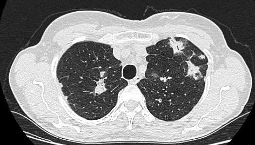 ! reverz halo sign Transzbronchialis