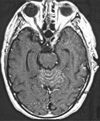 Paraneoplasiás cerebellaris degeneráció -hetek, hónapok alatt alakul ki -progresszív cerebellaris tünetek -lassan rosszabbodó törzs és járási ataxia -fokozódó végtag ataxia -teljes járásképtelenség