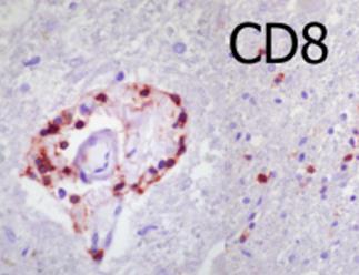 irreversibilis T-cell-mediálta destrukciója a Purkinje-sejteknek A